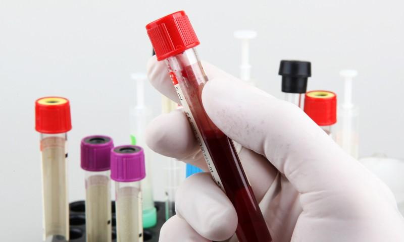 Exame de sangue que aponta Alzheimer pode chegar ao país em um mês