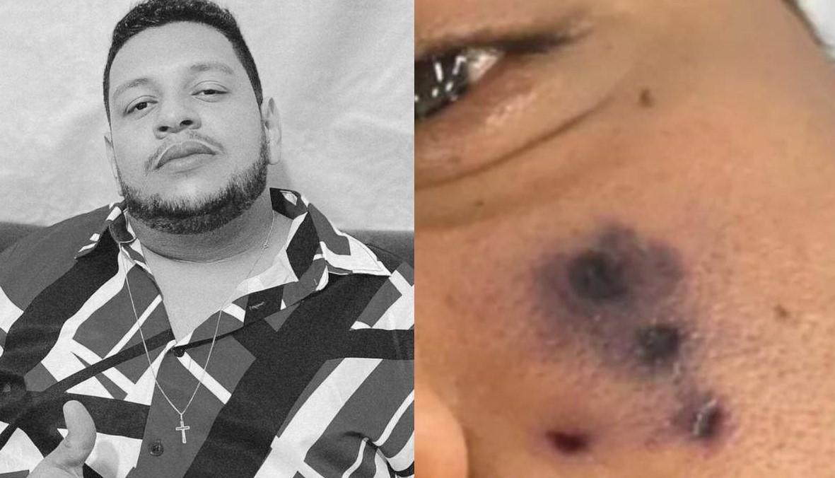 Cantor de forró morre após ser picado por aranha; 