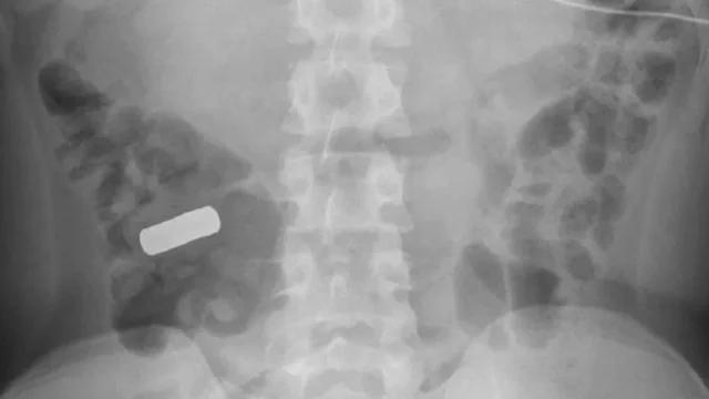 Médicos encontram 21 ímãs no intestino de adolescente com cólicas abdominais