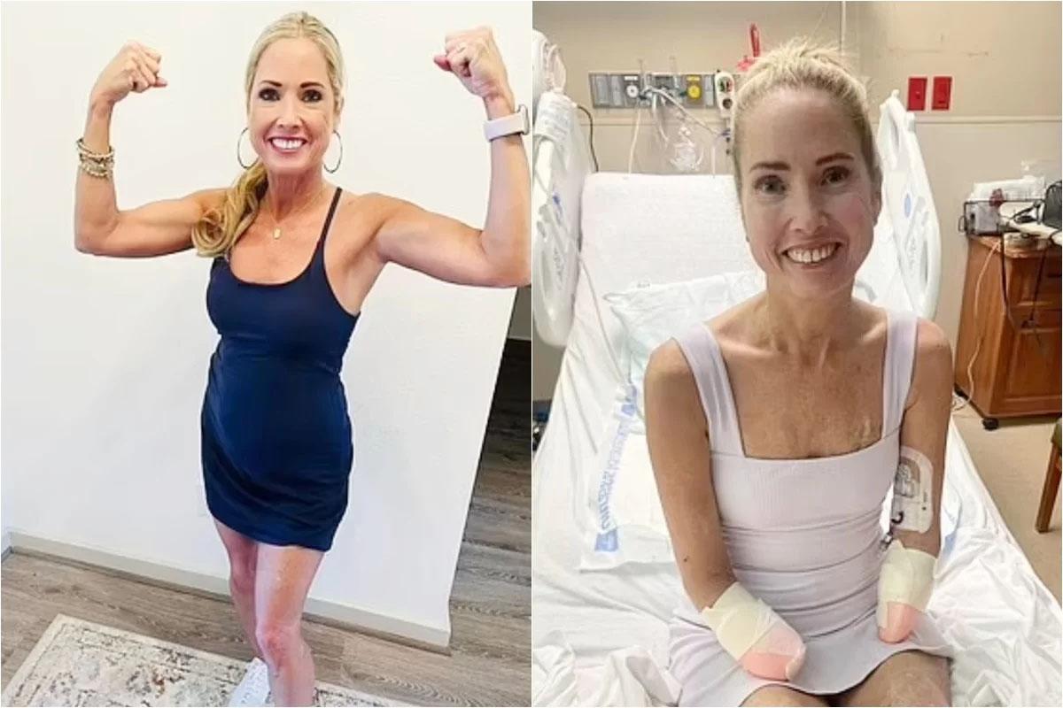Mulher tem mãos e pés amputados após dor de garganta levar à sepse